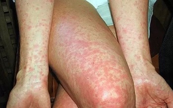 Аллергическая сыпь на руках и ногах