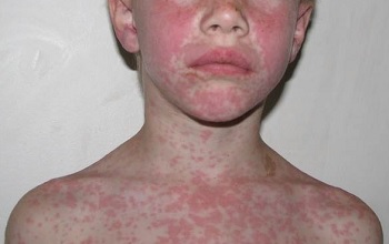 Аллергическая сыпь по всему телу у ребенка