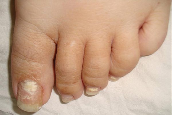 Способы лечения микоза ногтей на ногах народными методами