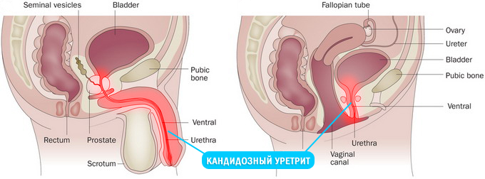 Кандидозный уретрит у мужчины и женщины