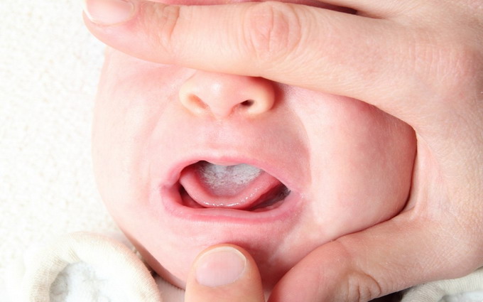 Молочница у ребенка во рту
