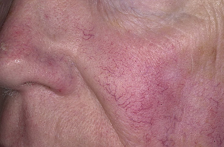 Сосуды кожи: расположение, особенности кровоснабжения, проблемы с кожными сосудами.