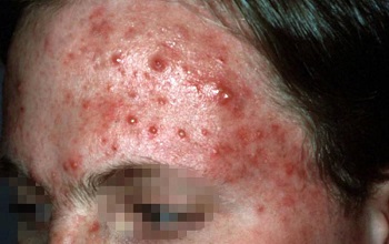 Угревая сыпь на лице у взрослого причины и лечение в домашних