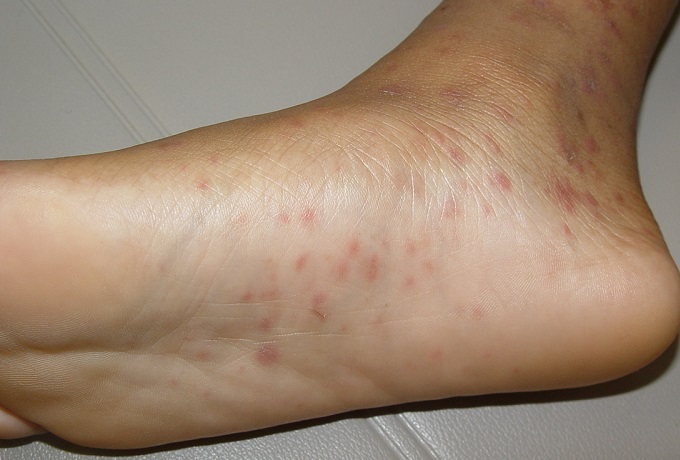 Как быстро вылечить кожную аллергию