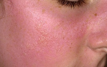 Чем лечить фотодерматоз – аллергию на солнце