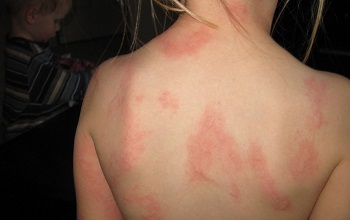 Что принять от аллергии на коже