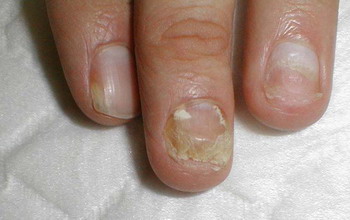 Лечение микоза на ногтях рук в домашних условиях. Популярные народные способы