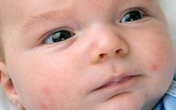 Причины появления и симптомы акне у новорожденных. Современные методы лечения и профилактики высыпаний у детей