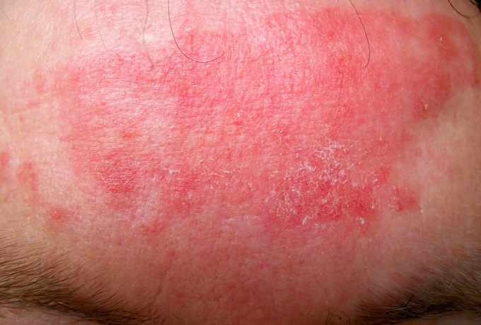Чем лечить аллергию на коже
