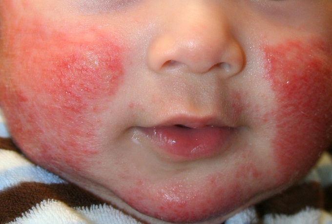 Лечение при аллергии на коже