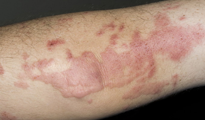 Аллергическая экзема на руке