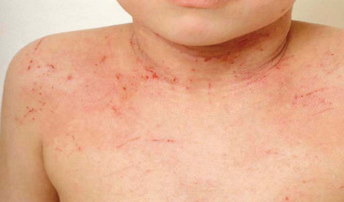 Аллергическая экзема у ребенка