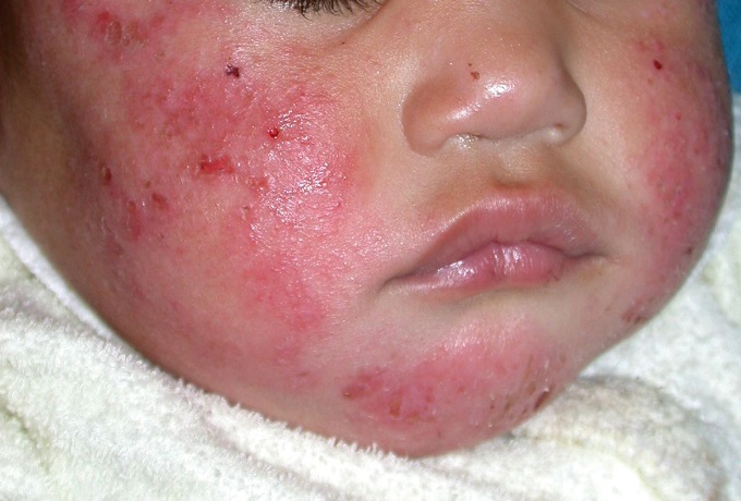 Аллергическая сыпь на лице младенца