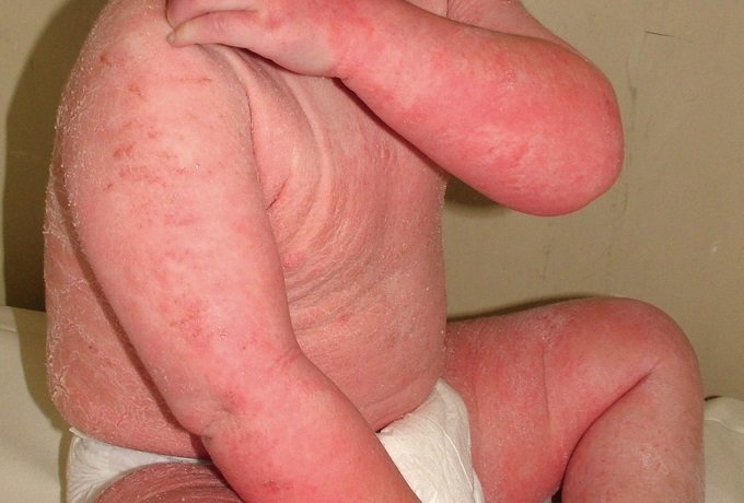 Аллергические высыпания на теле ребенка
