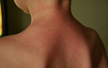 аллергия на солнцезащитные стредства