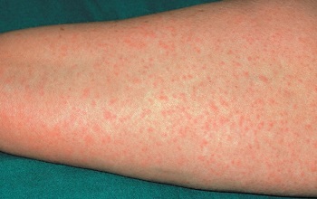 Аллергия в результате УФ-облучения