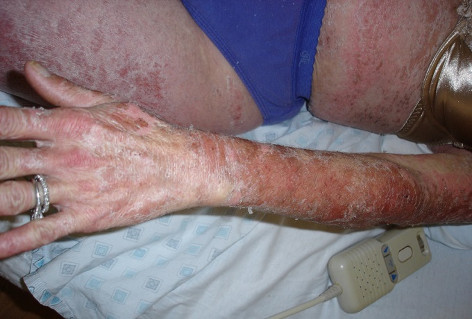 Чем лечат аллергию на коже
