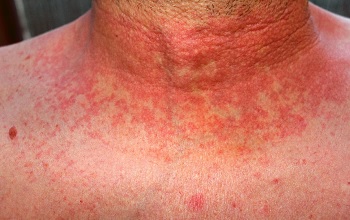 Причины появления и методы лечения аллергической сыпи на теле у взрослого человека