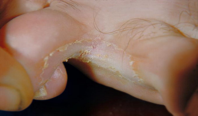 Эпидермофития между пальцами стопы