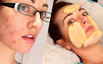 Рецепты из сырого и вареного картофеля для лечения прыщей на лице: маски, отзывы