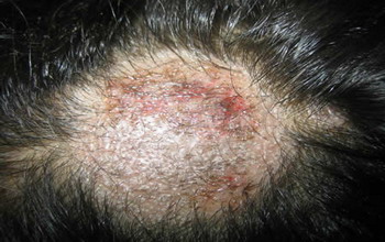 Грибковые заболевания кожи головы