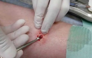 Хирургическая операция по удалению фурункула