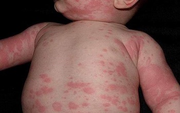 Лекарственные аллергены, дети