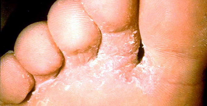 Микоз между пальцами на ноге