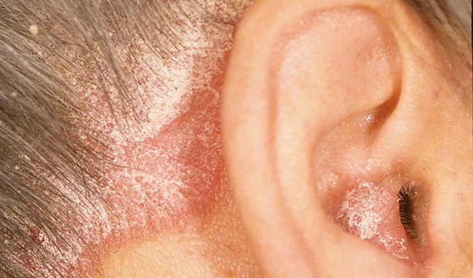 Микроспория на волосистой части кожи