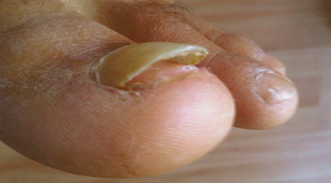 Отслоение ногтя на пальце ноги