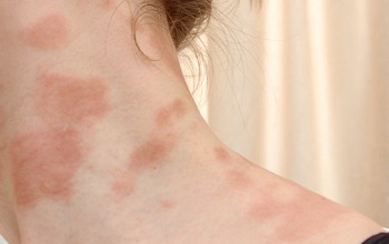 Как вылечить аллергию на теле у взрослого thumbnail