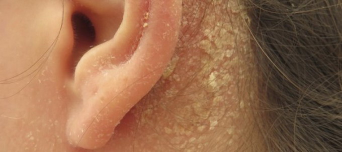 Себорейный дерматит за ушами