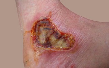 Термическая рана на ноге