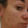 Особенности лечения угревой сыпи на лице у взрослого человека