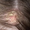 Грибковые заболевания на волосистой части головы