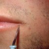 Плоские бородавки возле губ