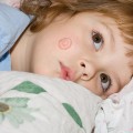 Лечение и профилактика стригущего лишая у ребенка