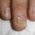 Лечение микоза на ногтях рук в домашних условиях. Популярные народные способы