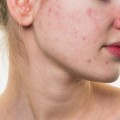 Причины появления угревой сыпи на лице и методы лечения