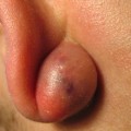 Причины появления, признаки и методы лечения атеромы в мочке уха