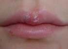 Герпес на верхней губе в процессе лечения