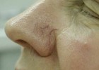 Расширение сосудов кожи на носу
