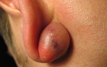 Причины появления, признаки и методы лечения атеромы в мочке уха