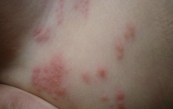Аллергия на бедре
