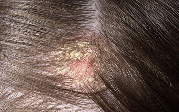 Грибковые заболевания на волосистой части головы