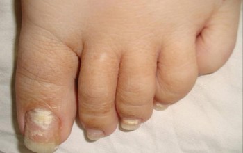 Способы лечения микоза ногтей на ногах народными методами