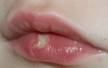 Мозоль на губе у ребенка
