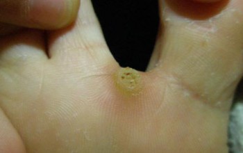 Стержневая (врастающая) мозоль между пальцами ног