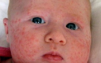 Угревая сыпь на лице у младенца